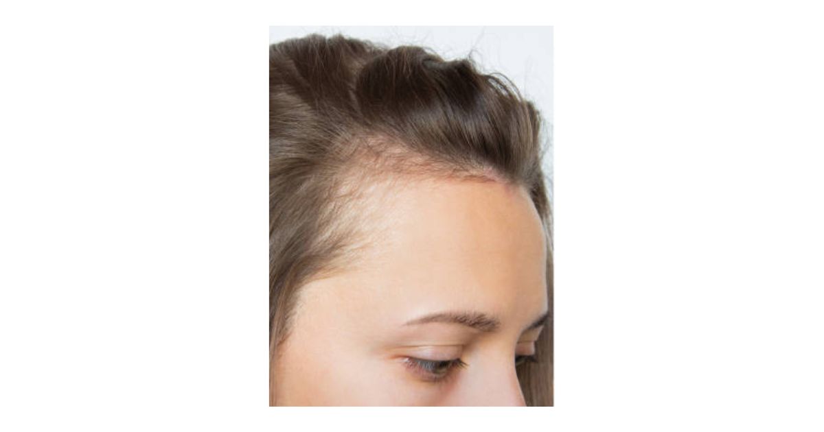 Thinning Hair needing Density