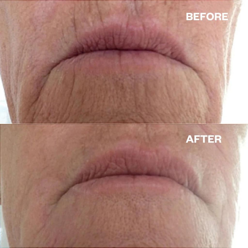 Wrinkles Schminkles Mouth & Lip Wrinkles Patches - Zennkai